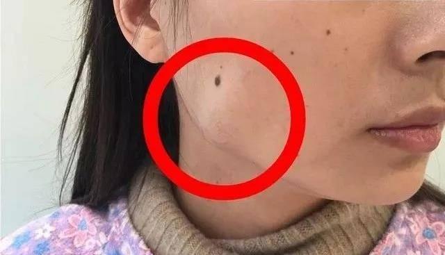 瘦脸针，价格与效果的平衡艺术
