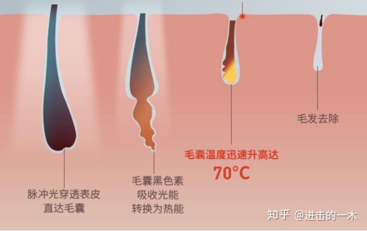 激光脱毛，从原理到体验——一次无痛与高效的美丽蜕变