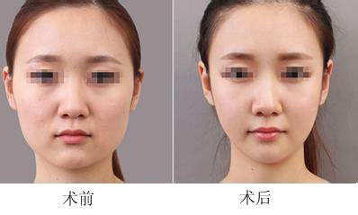 脸部吸脂，重塑精致轮廓的现代美容科技