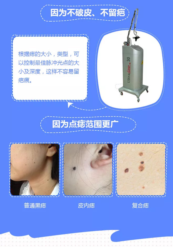 激光点痣，现代美容科技下的安全与美丽新选择