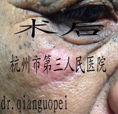 激光治痤疮，科技之光，照亮肌肤新生