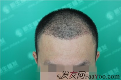 植发手术，重塑自信的美丽之旅