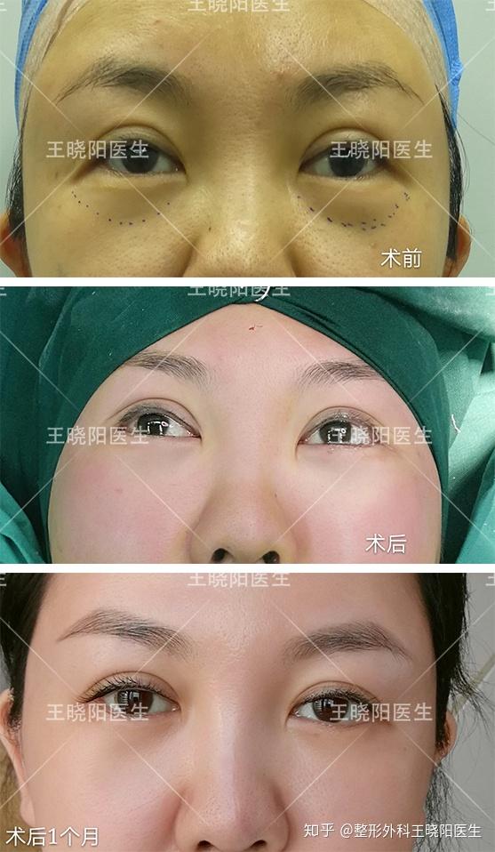 除眼袋手术，重拾青春的眼部美学