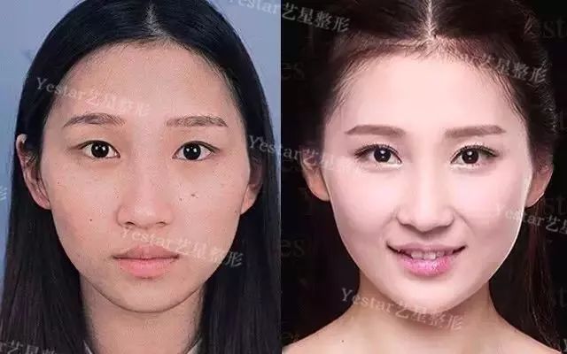 鼻子整容术，重塑自信的美丽之选