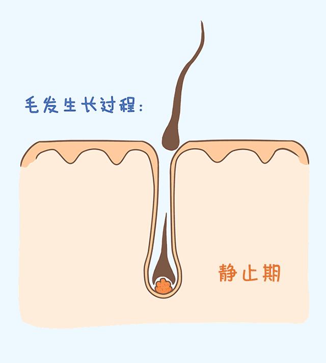 激光永久脱毛，价格、效果与选择的全面解析