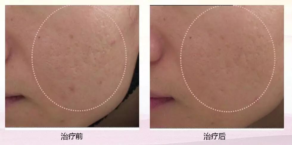 激光去痘坑，重塑肌肤自信的科技之选