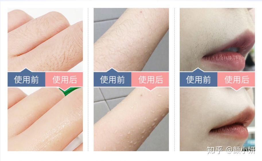 激光脱毛，现代美容的革新之选