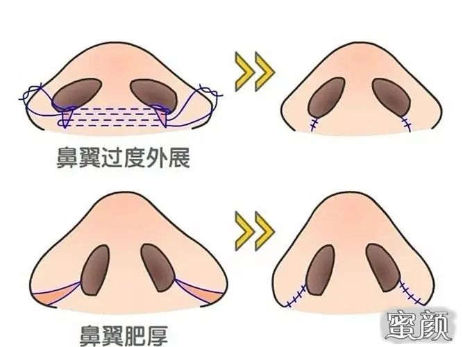 鼻翼大整容，重塑自信的美丽之旅