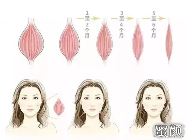打瘦脸针，价格、效果与安全性的全面解析