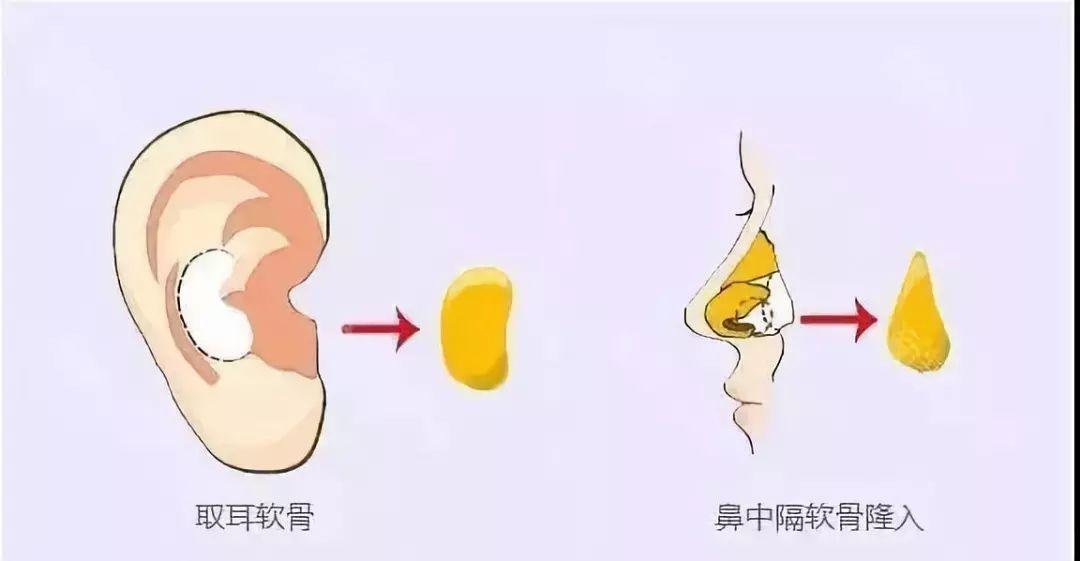 耳软骨隆鼻，美丽背后的隐忧