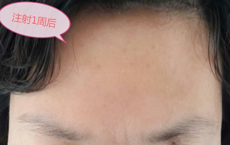 手术去除鱼尾纹，重拾青春的秘密武器