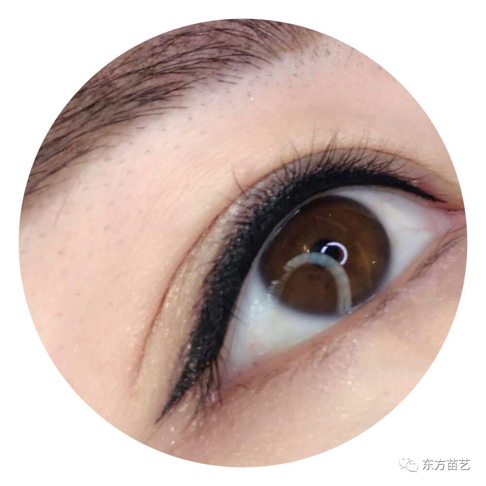 眼袋手术，重塑眼部青春的秘密武器