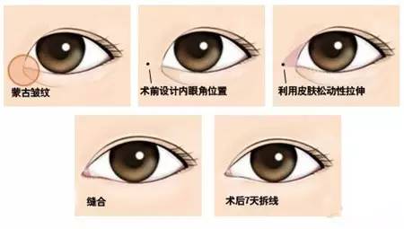 双眼皮手术与开眼角的完美结合，打造迷人眼眸的秘密
