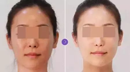 激光治疗黄褐斑，科学、安全与效果的完美结合