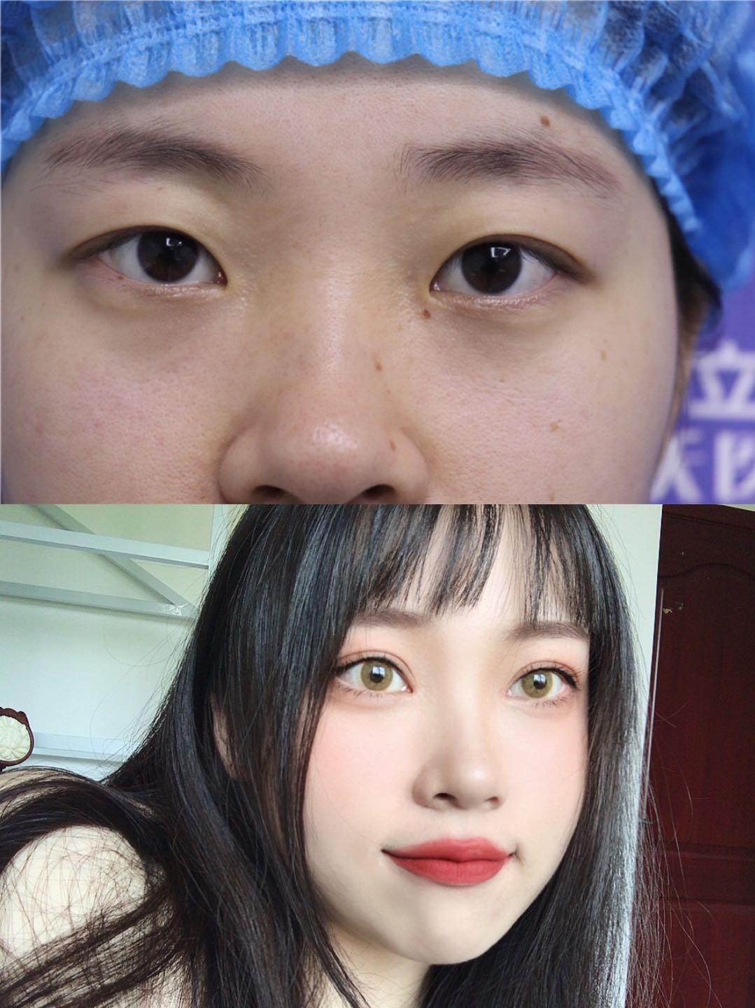探索美丽新视界，拉双眼皮手术全解析