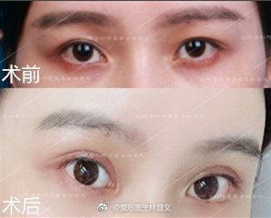 双眼皮修复，重塑眼部魅力的艺术