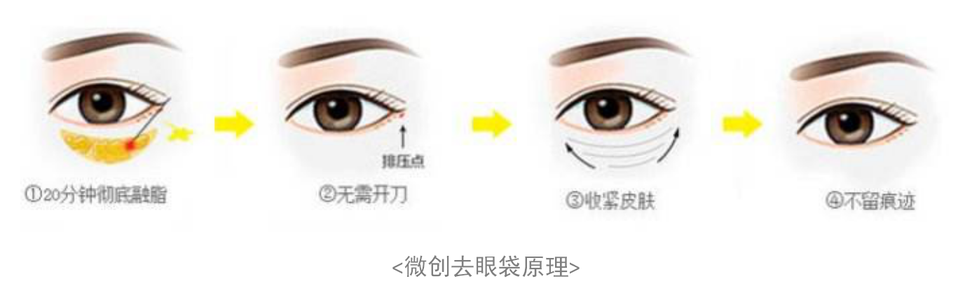 割眼袋手术，美丽与安全的平衡艺术