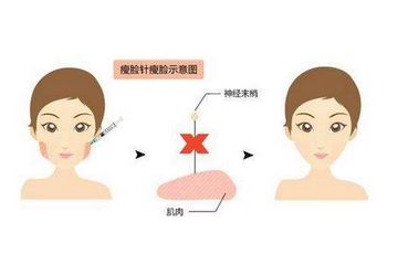 瘦脸针价格解析，一针背后的经济与美学考量