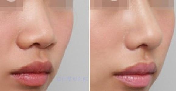 假体隆鼻取出手术费用解析，从价格到价值的全面考量
