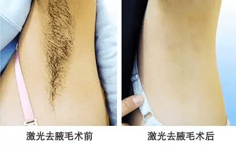 激光脱毛面部，安全、高效的美容新选择