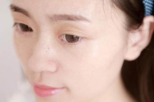 探索光动力祛痘，科学之光下的青春守护者