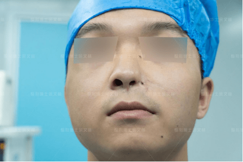 鼻翼缺损整形，重塑自信的美丽之旅