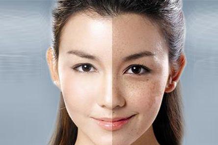 激光祛斑，科学、安全与效果的完美结合