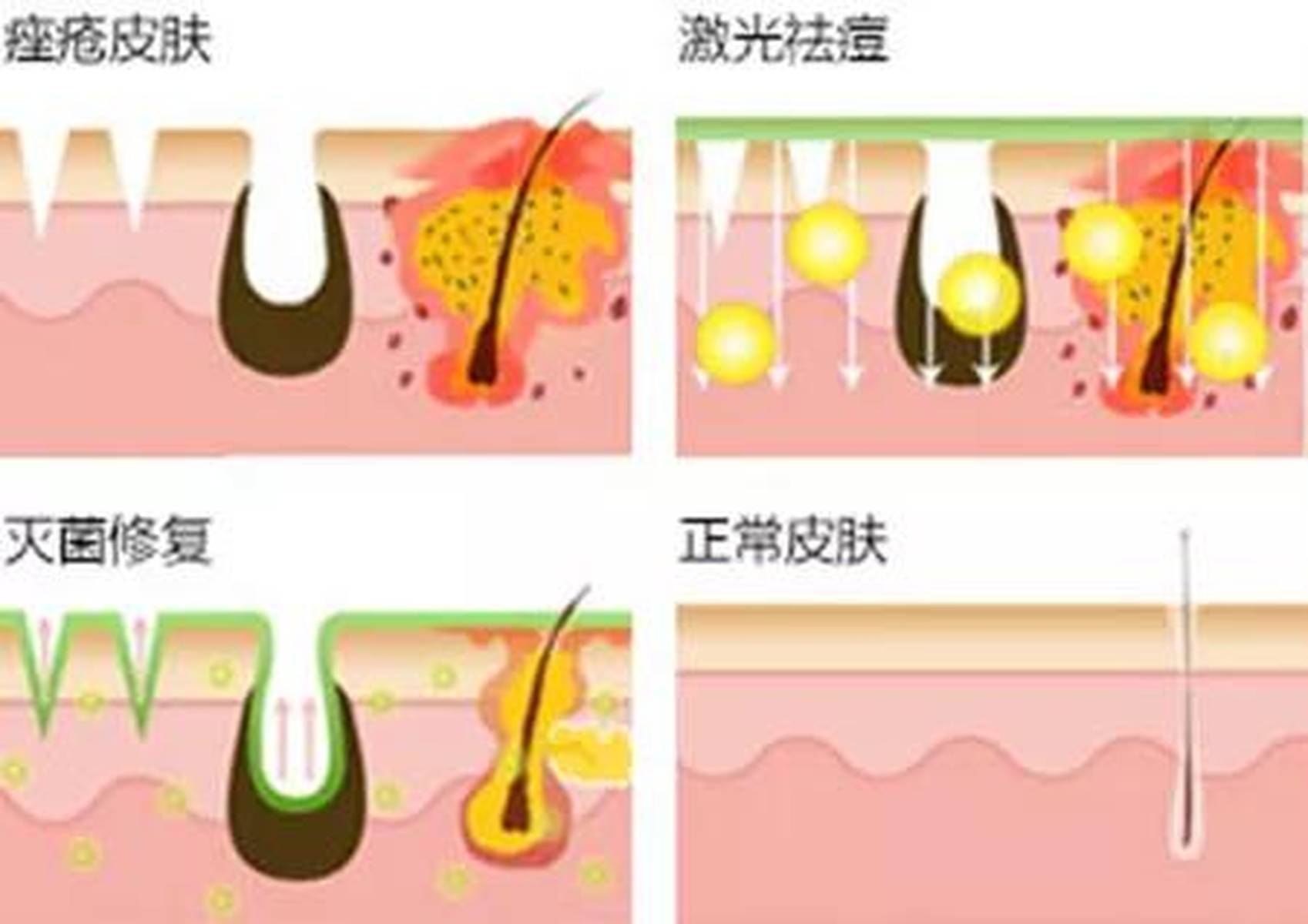 激光治疗痤疮，科技之光照亮肌肤健康之路