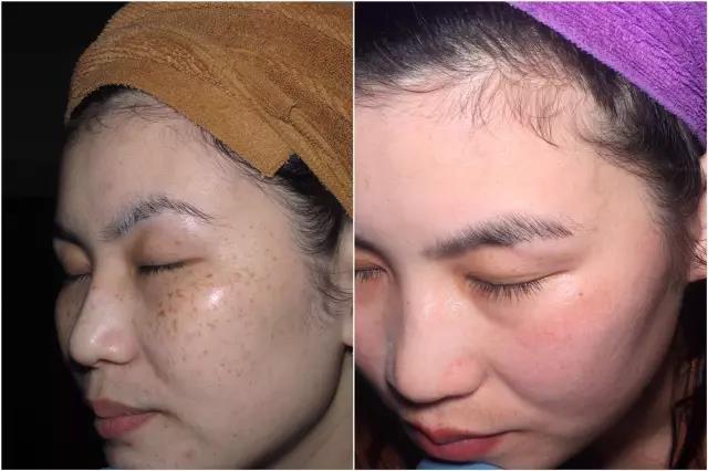 激光祛斑，科学之光下的美丽蜕变