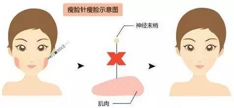瘦脸针，美丽背后的时间艺术