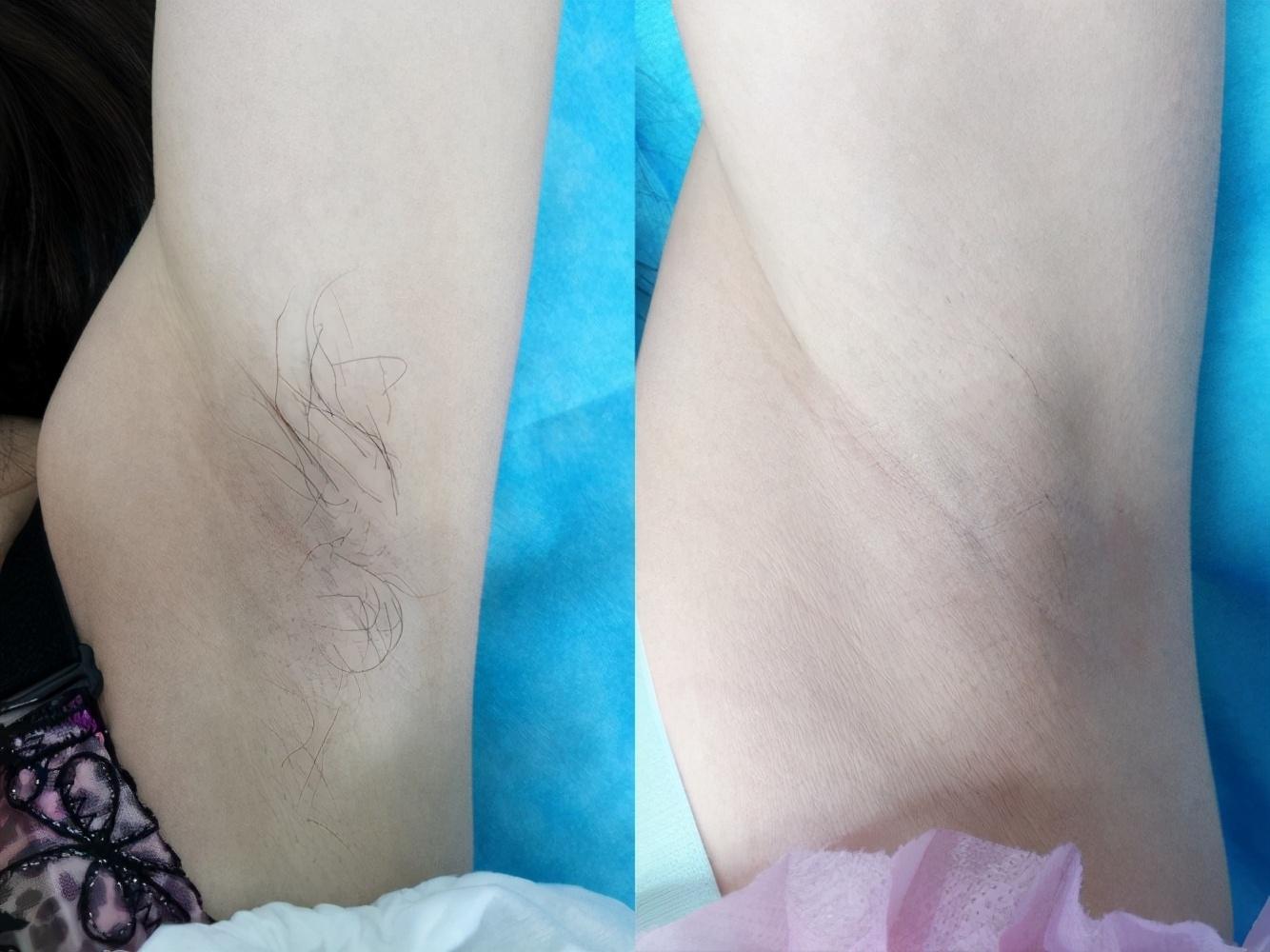 激光脱毛的利与弊，深入探讨其潜在危害