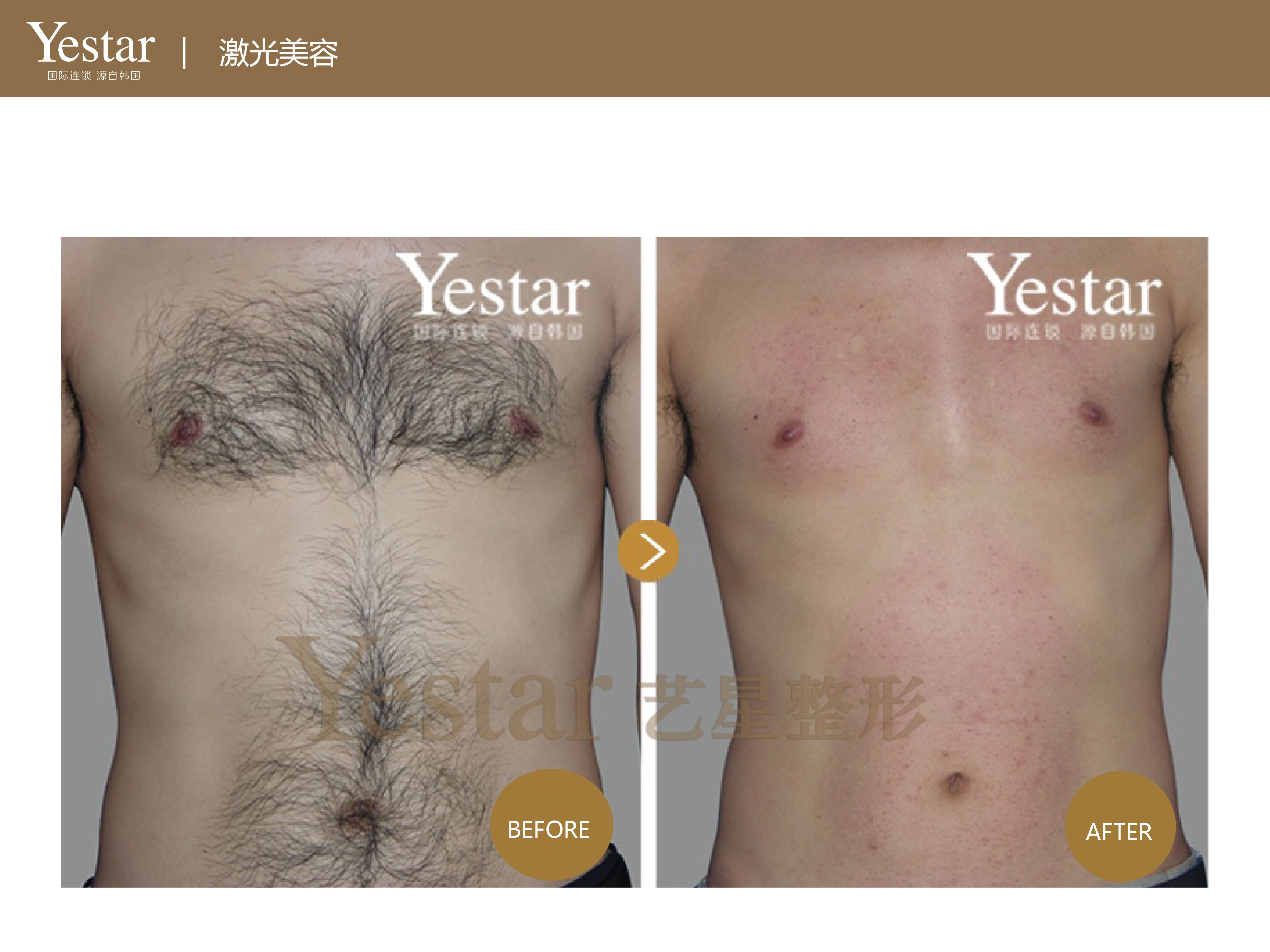 腿脱毛，从尴尬到自信的美丽蜕变