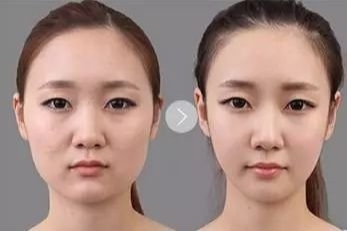 瘦脸针，效果与真相的深度解析