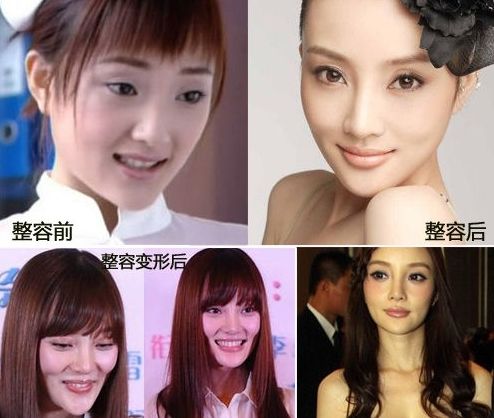 整容之谜，小祯的美丽蜕变