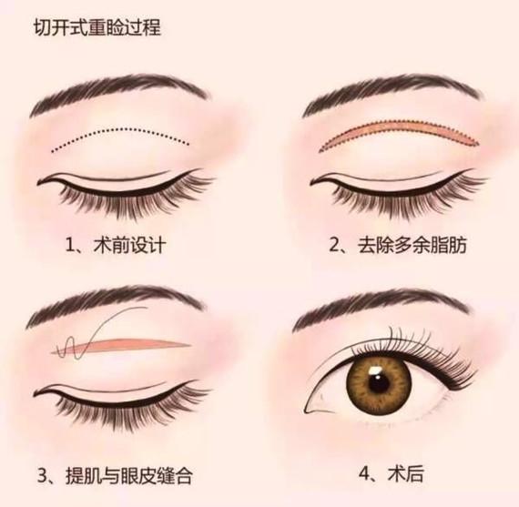埋线双眼皮的持久魅力，时间与美丽的艺术