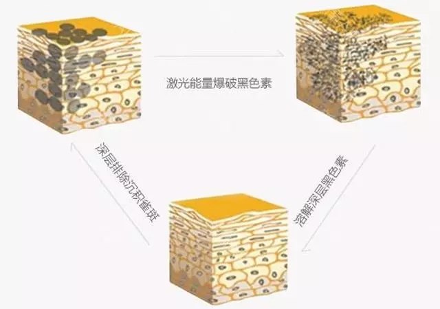 激光去黄褐斑，科技之光，照亮肌肤的净透之旅