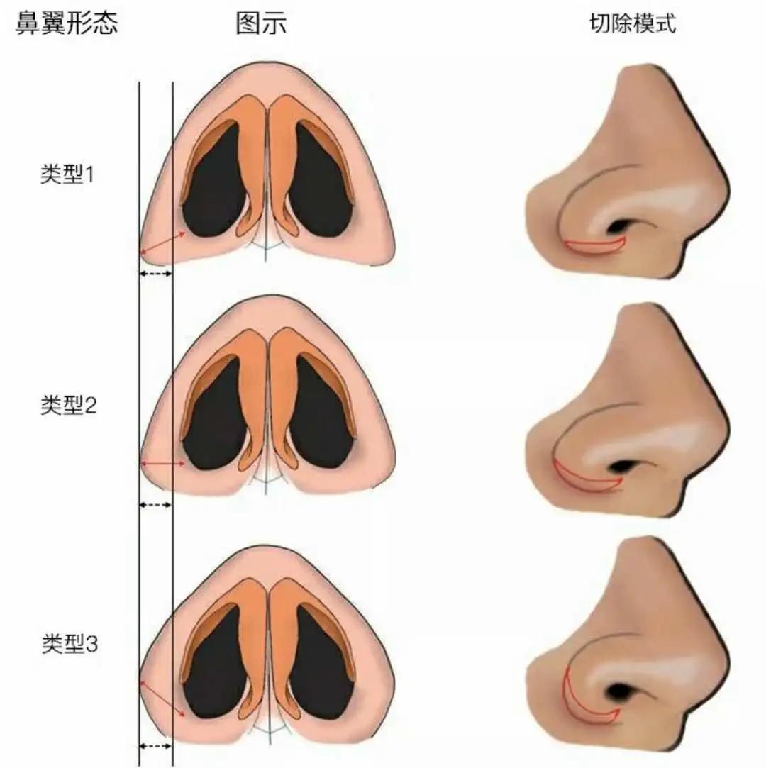 鼻翼缩小手术，重塑自信的美丽选择