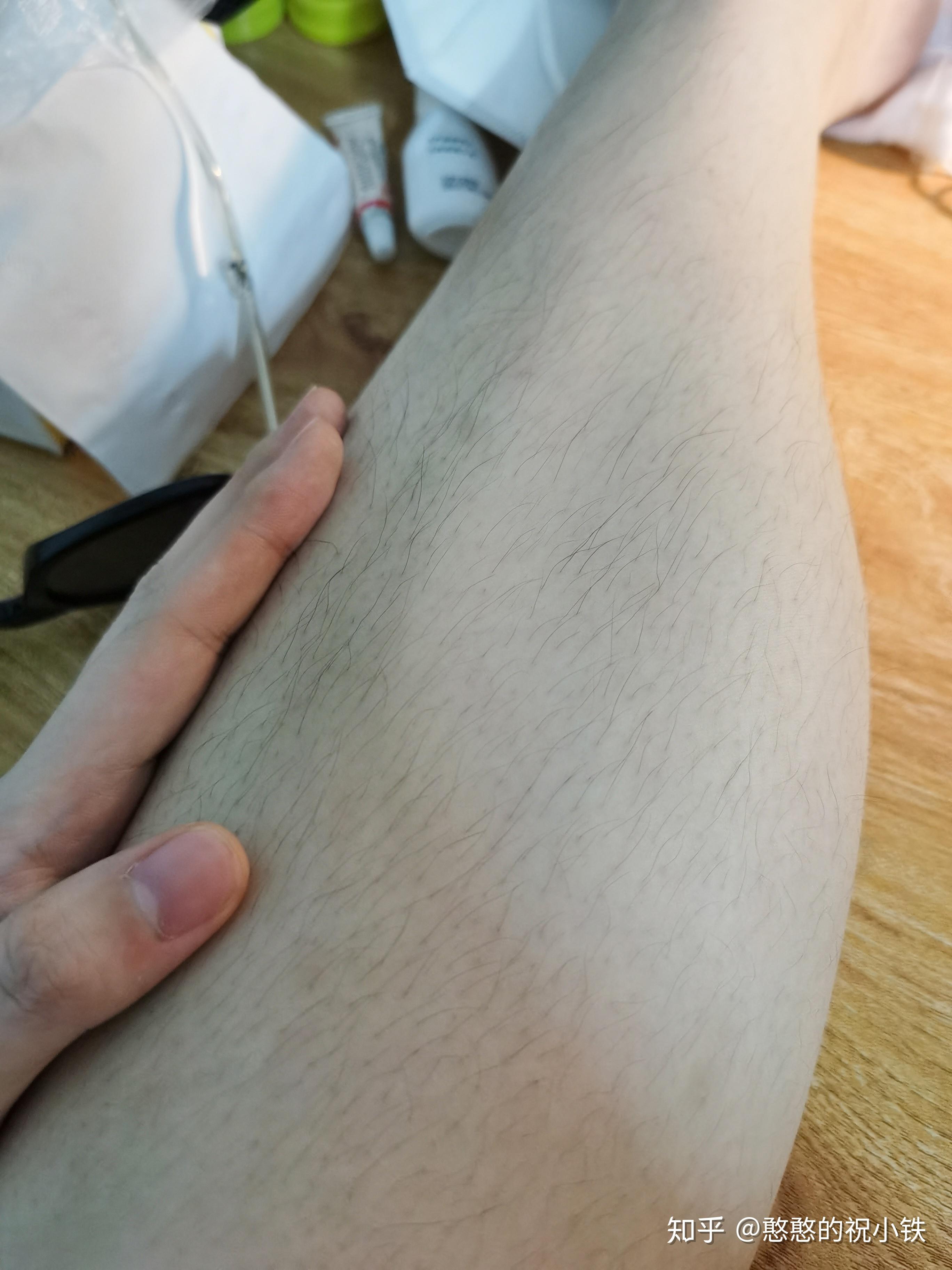 脱毛膏，能否实现永久性脱毛？