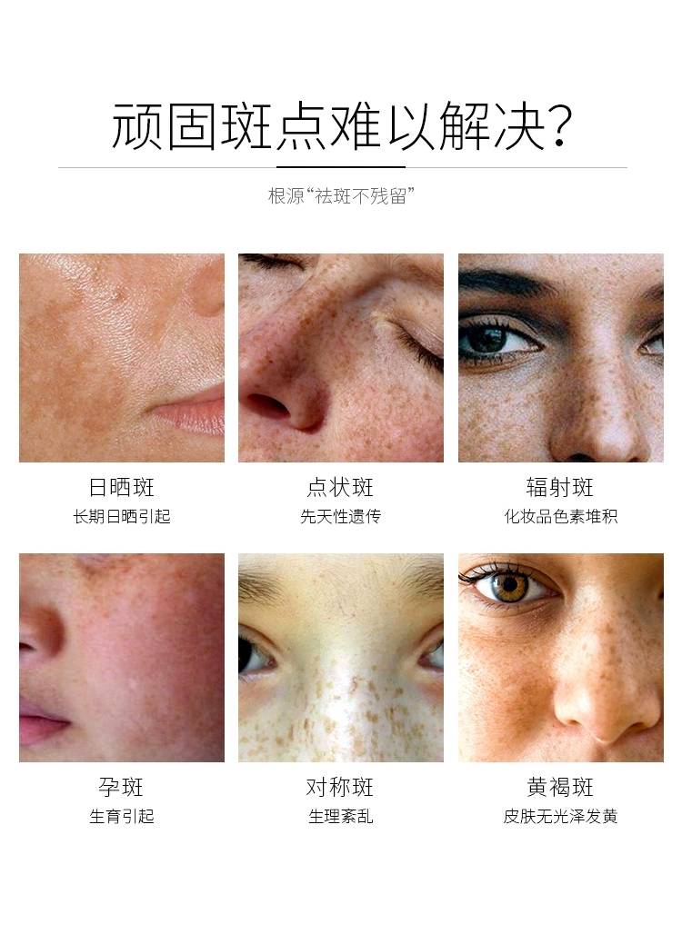 哪种产品祛斑效果好，科学解析与消费者指南