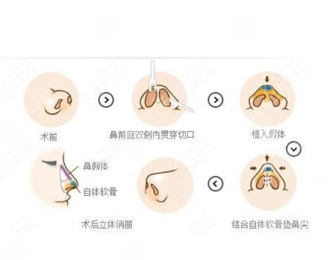 注射隆鼻，材料与选择指南