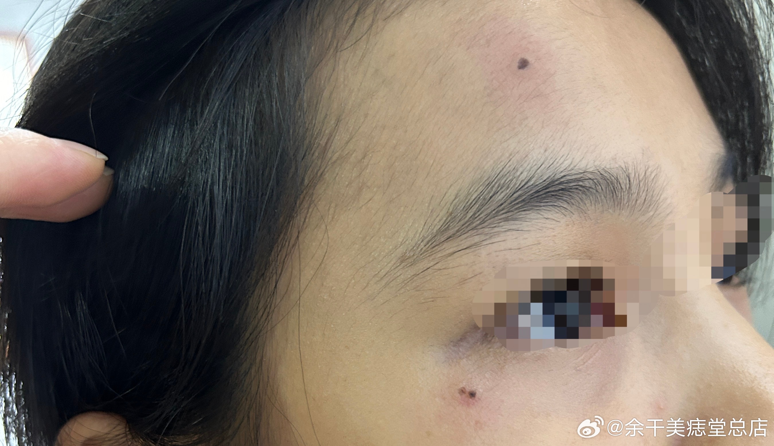 美容去痣，从困扰到自信的美丽蜕变