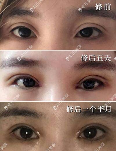 开双眼皮，美丽与自信的双重提升