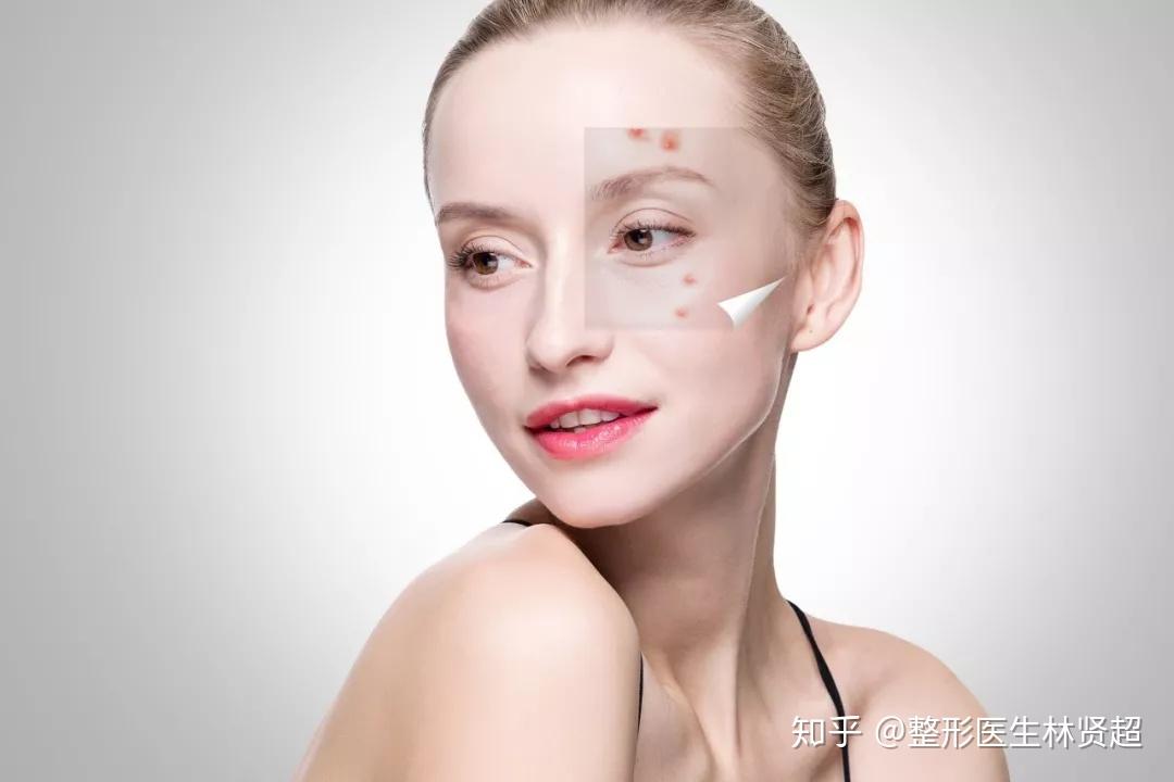 激光祛痘痘，科技之光，照亮肌肤的净透之路