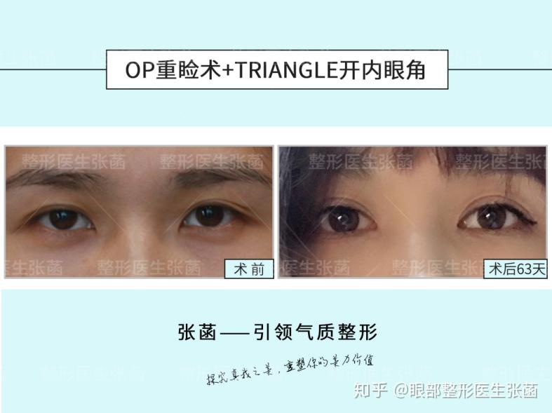 韩式三点双眼皮，美丽蜕变的艺术与科学