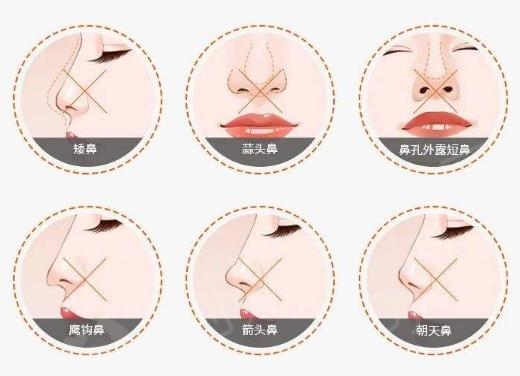 探索自体骨隆鼻，重塑鼻部形态的自然美学