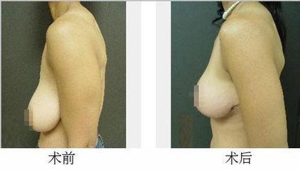 胸部下垂整形术，重塑自信与美丽的艺术