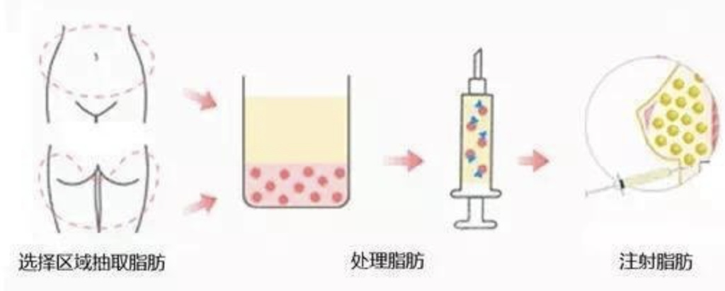 注射丰胸手术，美丽背后的科学与风险