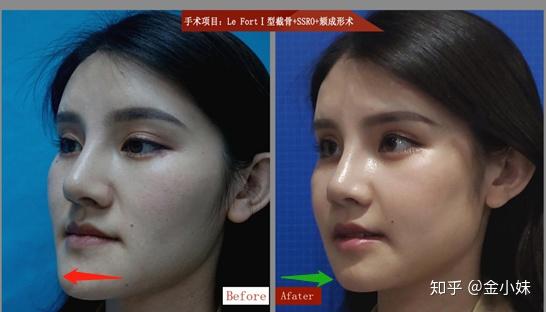 削骨手术，重塑美丽轮廓的现代医学艺术