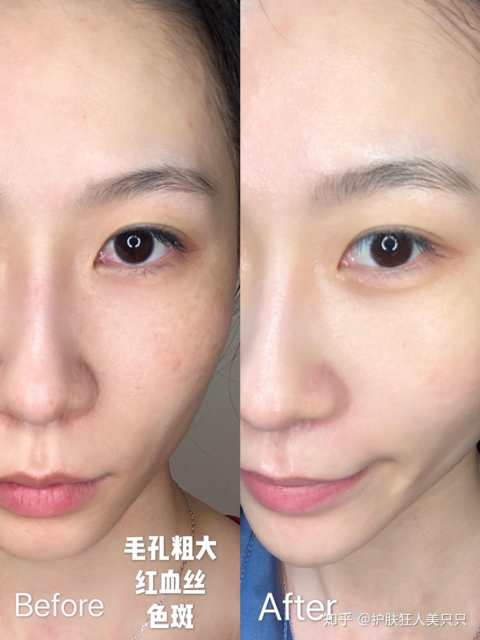 做光子嫩肤，解锁肌肤年轻态的秘密武器