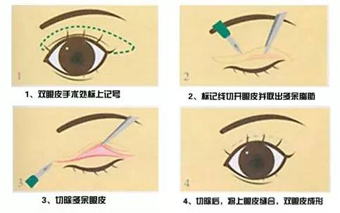探索无痕双眼皮手术，自然之美的秘密